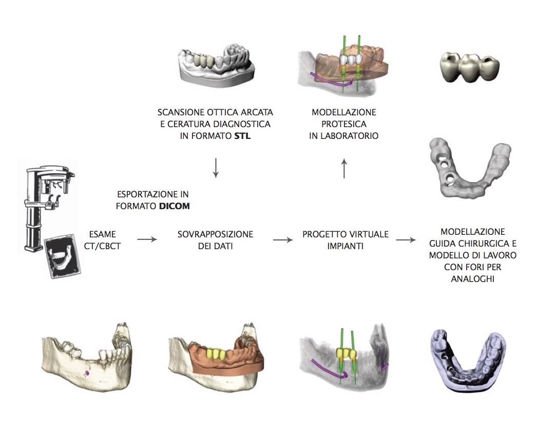 Featured image for “What is computer guided implantology?”